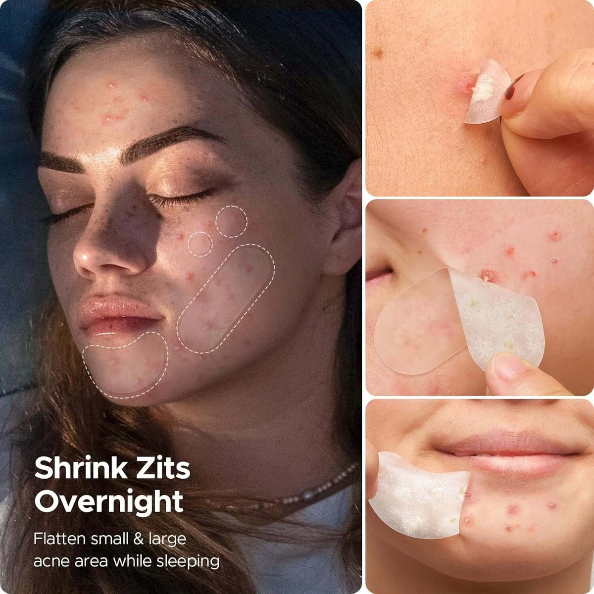 Pimple Patches for Face, 5 Sizes 400 Counts Hydrocolloid Acne Patch, Day & Night Spot Stickers Variety Pack, Thin & Thick for Covering Zits, Pimples, Large Breakouts, Chin, Forehead