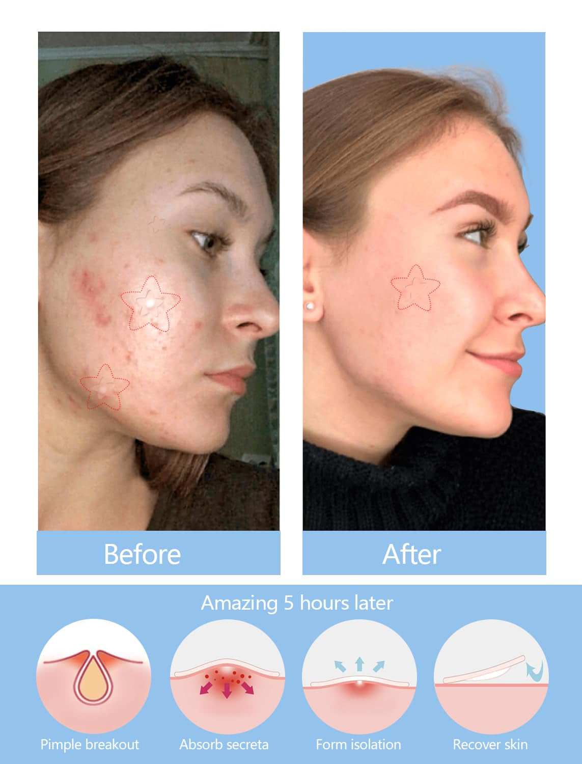 Clear Star Pimple Patches for Face, 153 Count Hydrocolloid Star Acne Patches Invisible, Cute Zit Covers for Face, Spot Stickers with Tea Tree, Salicylic Acid and Cica Oil