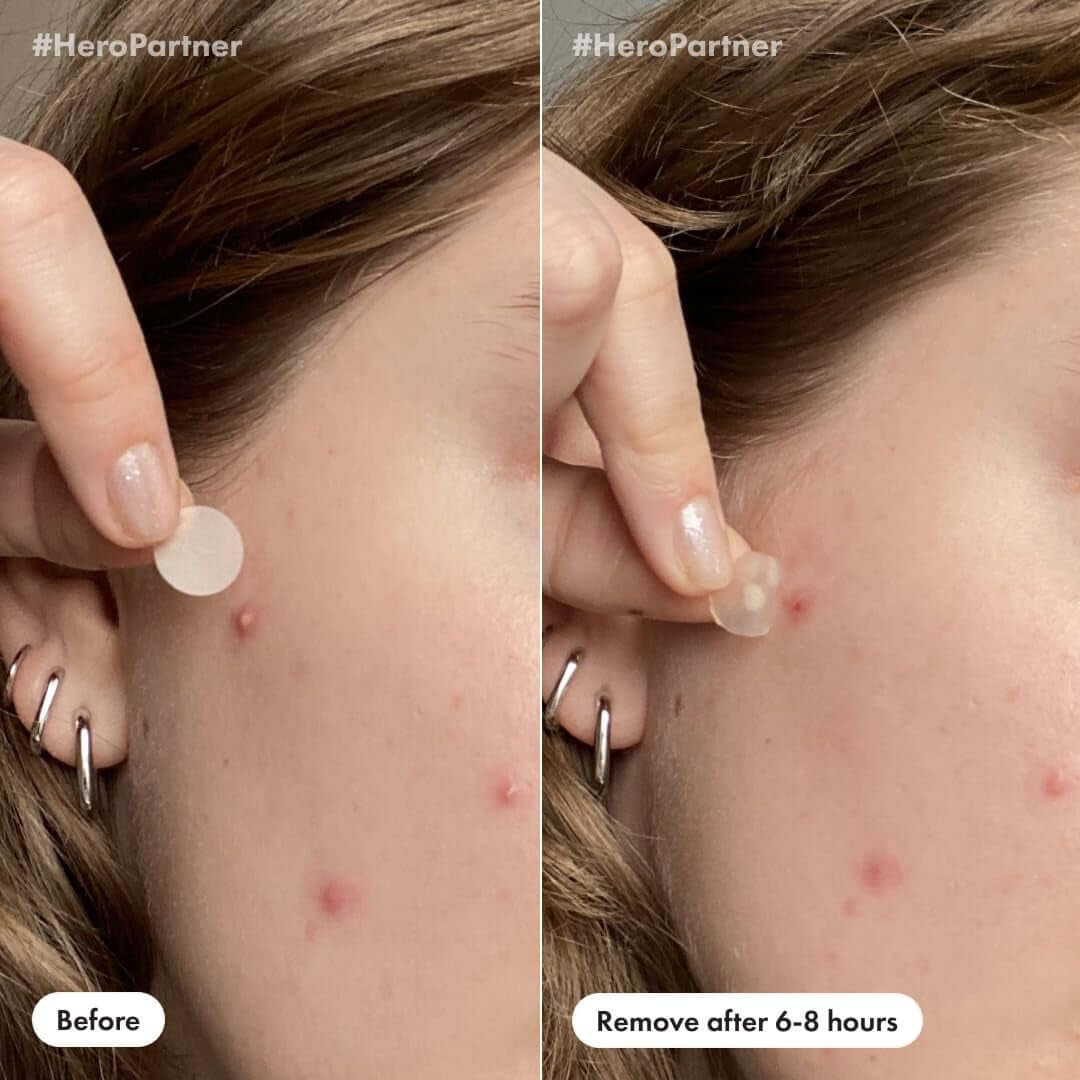 Hero Cosmetics Day and Night Acne Pimple Patches, 36 Ct | 18X Original + 18X Invisible+ Patches, Absorbs Pimple Gunk in 6-8 Hours, Medical-Grade Hydrocolloid, Dermatologist-Tested