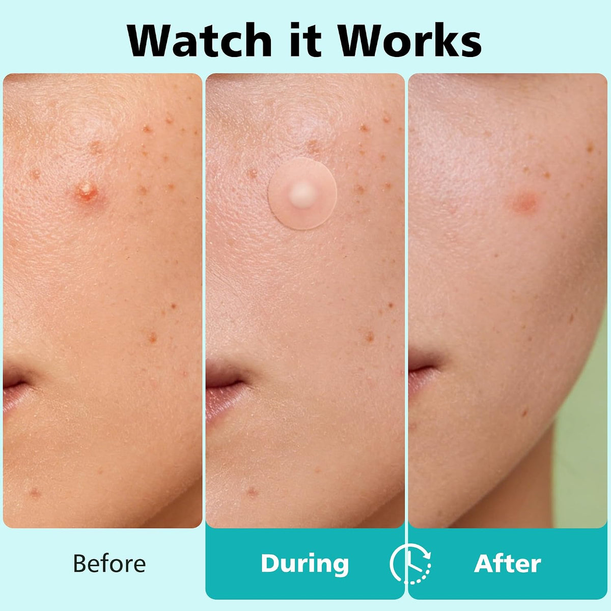 4 Size 600 Counts Pimple Patches, Acne Patches for Face | Hydrocolloid Patches for Covering Zits and Blemishes, Spot Stickers with Salicylic Acid, Tea Tree Oil & Calendula Oil